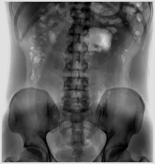 Quantitative Ultrasonic Bone Densitometry