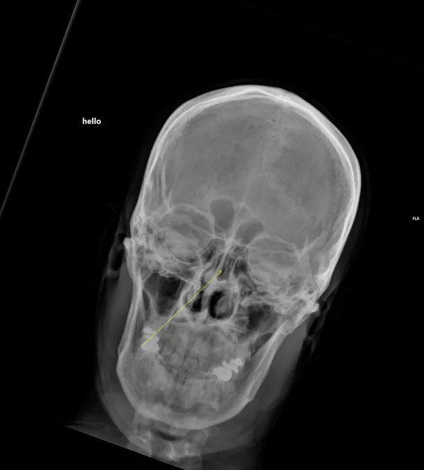 Digital X-ray machine