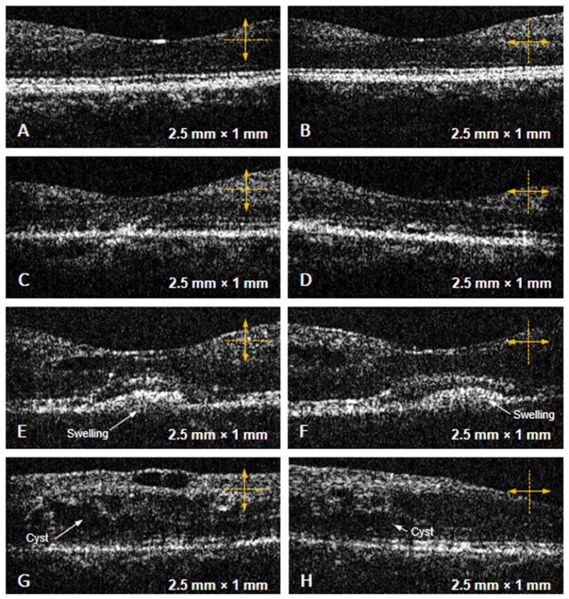 OCT images of the macular region of the retina in patients with various stages of diabetic retinopathy.